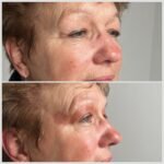 deutliche und sofortige Glättung feiner Linien am Auge