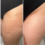 Dehnungsstreifen am Oberschenkel, striae albae