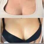 deutliche Verbesserung der Dehnungsstreifen nach 1 Behandlung